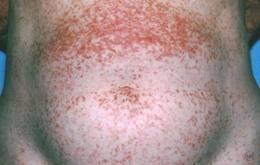 What causes hives in adults?